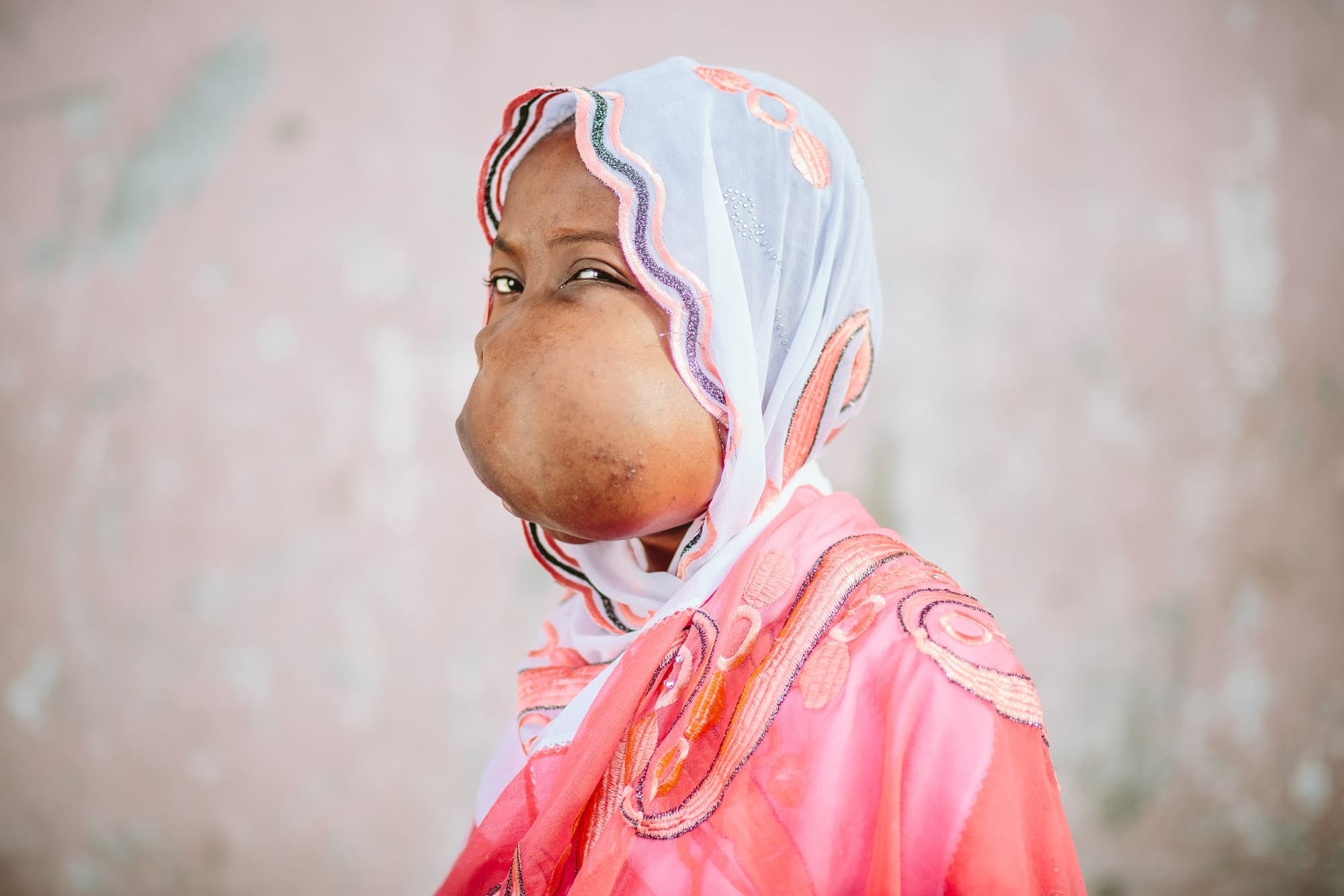 Jeune fille atteinte d'une tumeur faciale avant son opération en Afrique, malformation