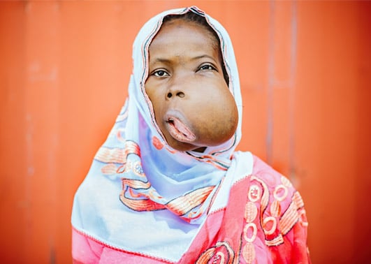 Tumeur faciale : découvrez le combat pour la vie de Mabouba